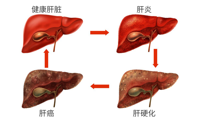 肝脏‘不喜酒’？